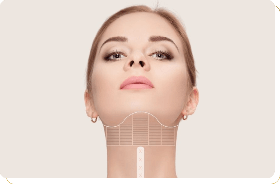 Área de atuação do procedimento Ultra Double Chin com Ultraformer III